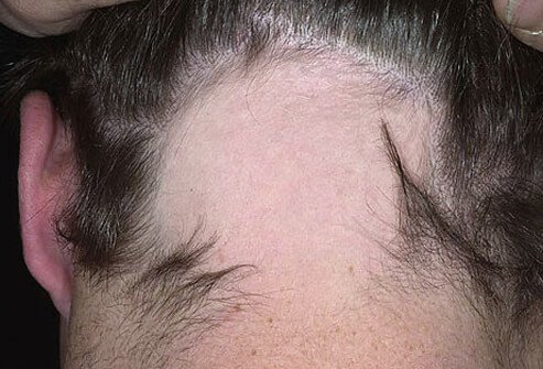 Alopecia Areata