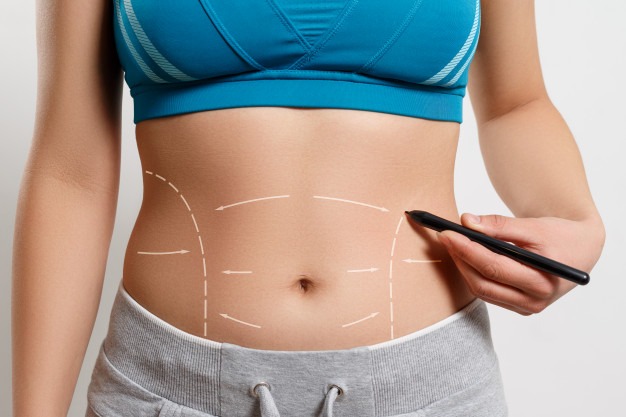 Bauchdeckenstraffung (Bauchstraffung (Abdominoplastik))