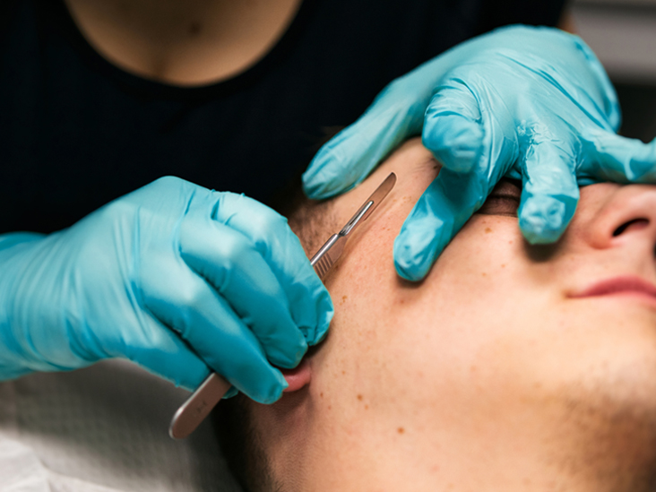 Wenn Dermaplaning schief geht: Lassen Sie sich das nicht passieren!