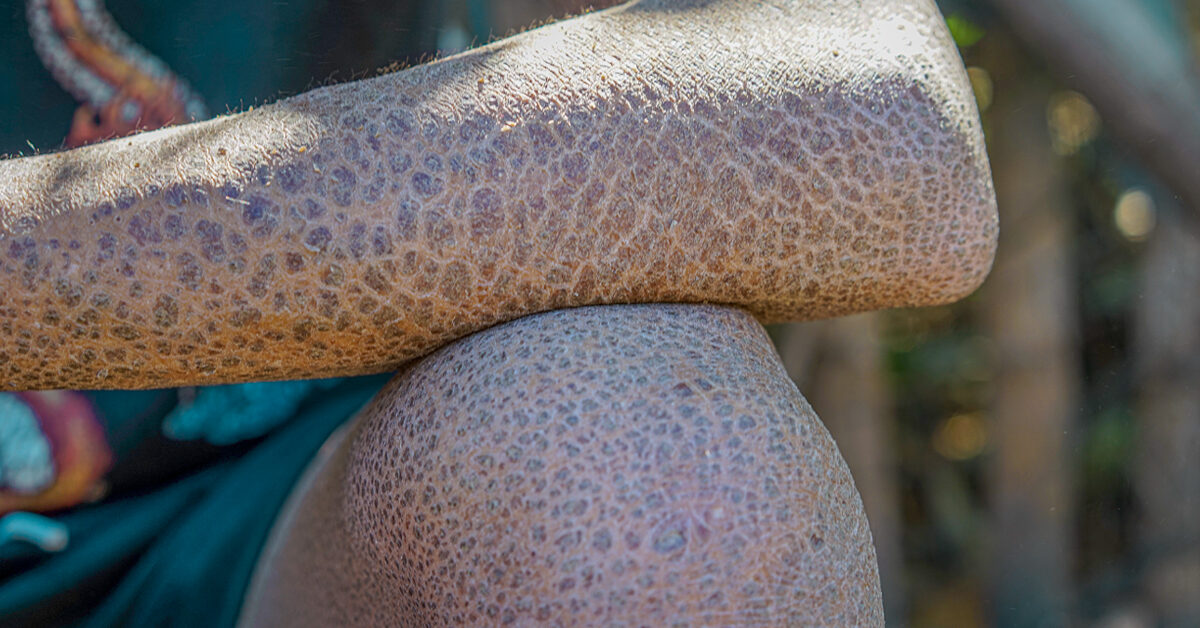 Ekzem bei Erwachsenen: Symptome, Diagnose und Behandlung