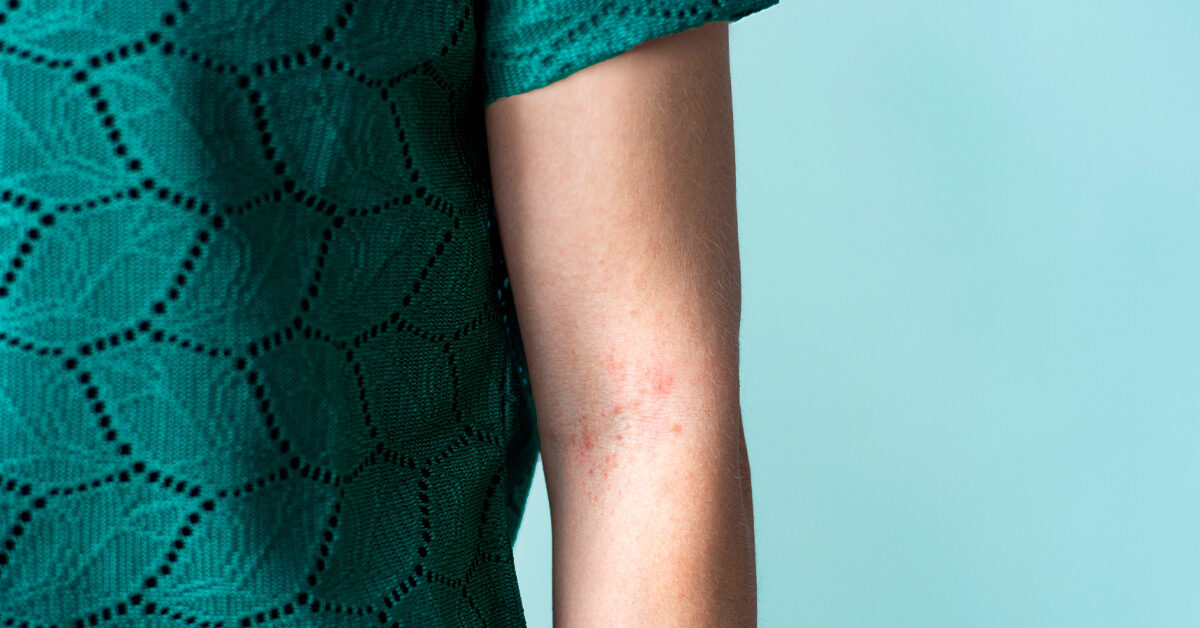 Wie man Taltz bei Psoriasis einnimmt: Schritte zur Selbstinjektion und mehr