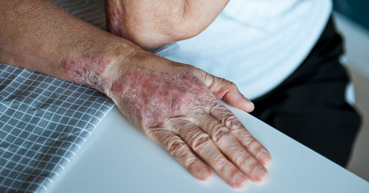 Psoriasis-Ausschlag: Typen, Bilder und mehr