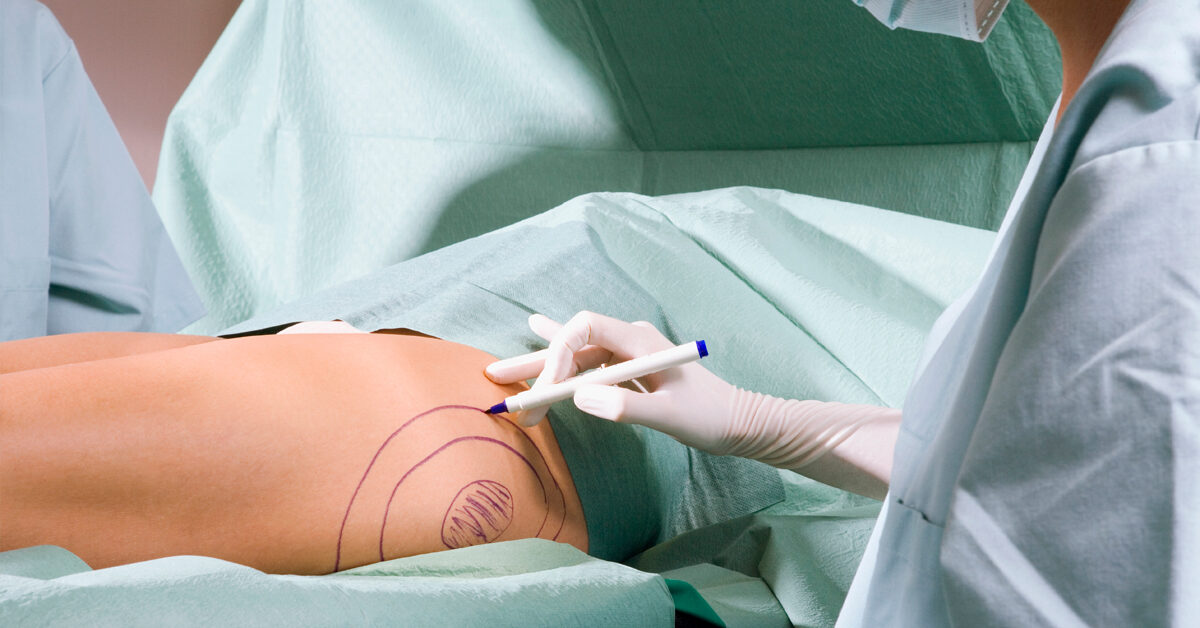 Vorteile der Tumeszenz-Liposuktion, Vorsichtsmaßnahmen, Bilder und Kosten